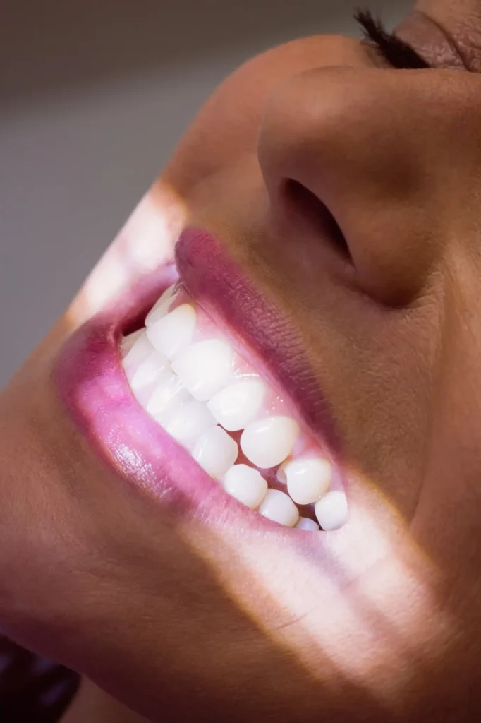 E-max Veneers