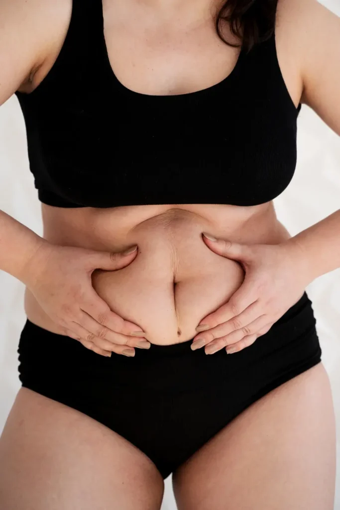 Liposuction